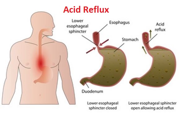 causes of acid reflux